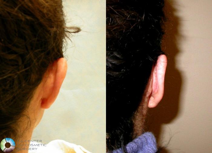 Before & After Ear Surgery Case 69 View #1 in Denver and Colorado Springs, CO