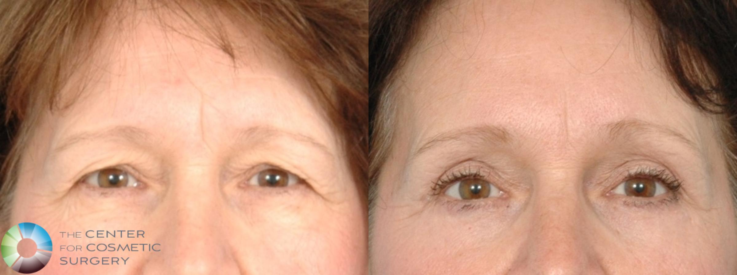 Before & After Eyelid Lift Case 11843 Front View in Golden, CO