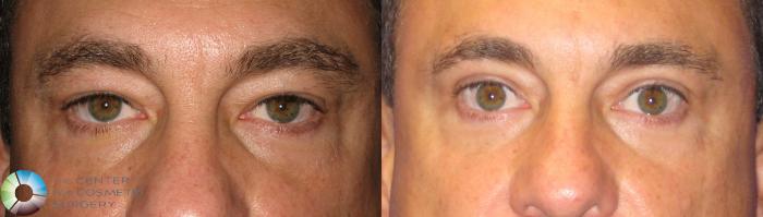 Before & After Eyelid Lift Case 237 View #1 in Denver and Colorado Springs, CO