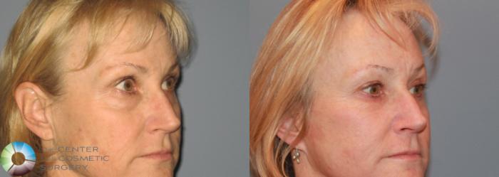 Before & After Eyelid Lift Case 494 View #1 in Denver and Colorado Springs, CO