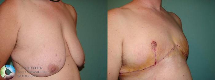 Before & After FTM Top Surgery/Chest Masculinization Case 10915 Right Oblique in Denver, CO