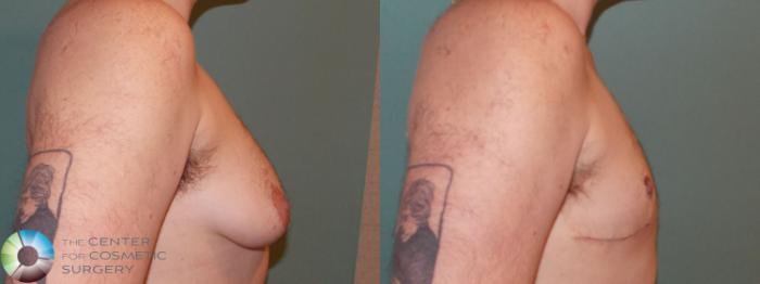 Before & After FTM Top Surgery/Chest Masculinization Case 11040 Right Lateral in Denver and Colorado Springs, CO