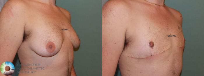 Before & After FTM Top Surgery/Chest Masculinization Case 11040 Right Oblique in Denver and Colorado Springs, CO