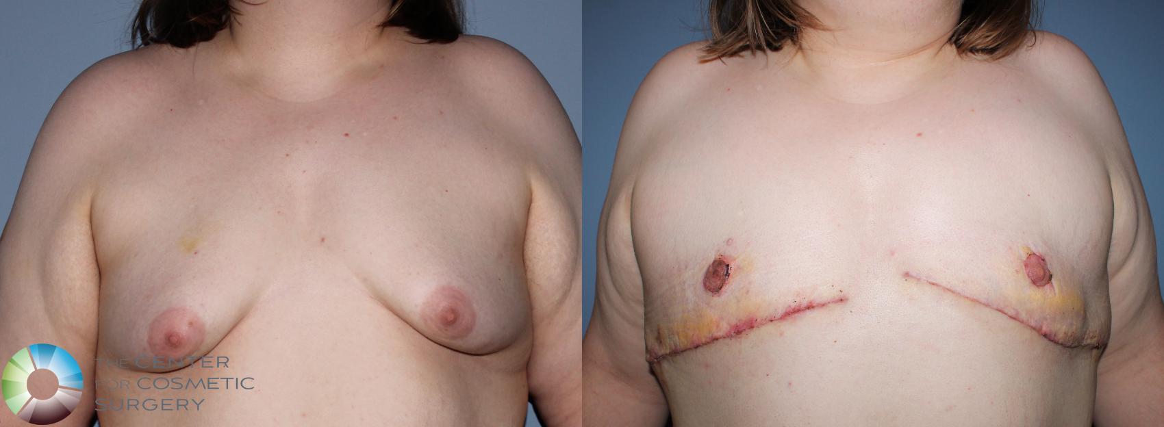 Before & After FTM Top Surgery/Chest Masculinization Case 11200 Front in Denver and Colorado Springs, CO