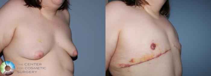 Before & After FTM Top Surgery/Chest Masculinization Case 11200 Right Oblique in Denver and Colorado Springs, CO