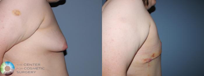 Before & After FTM Top Surgery/Chest Masculinization Case 11200 Right Side in Denver and Colorado Springs, CO