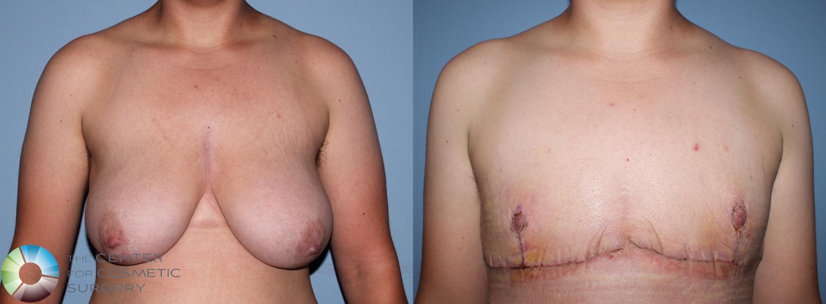 Before & After FTM Top Surgery/Chest Masculinization Case 11201 Front in Denver and Colorado Springs, CO