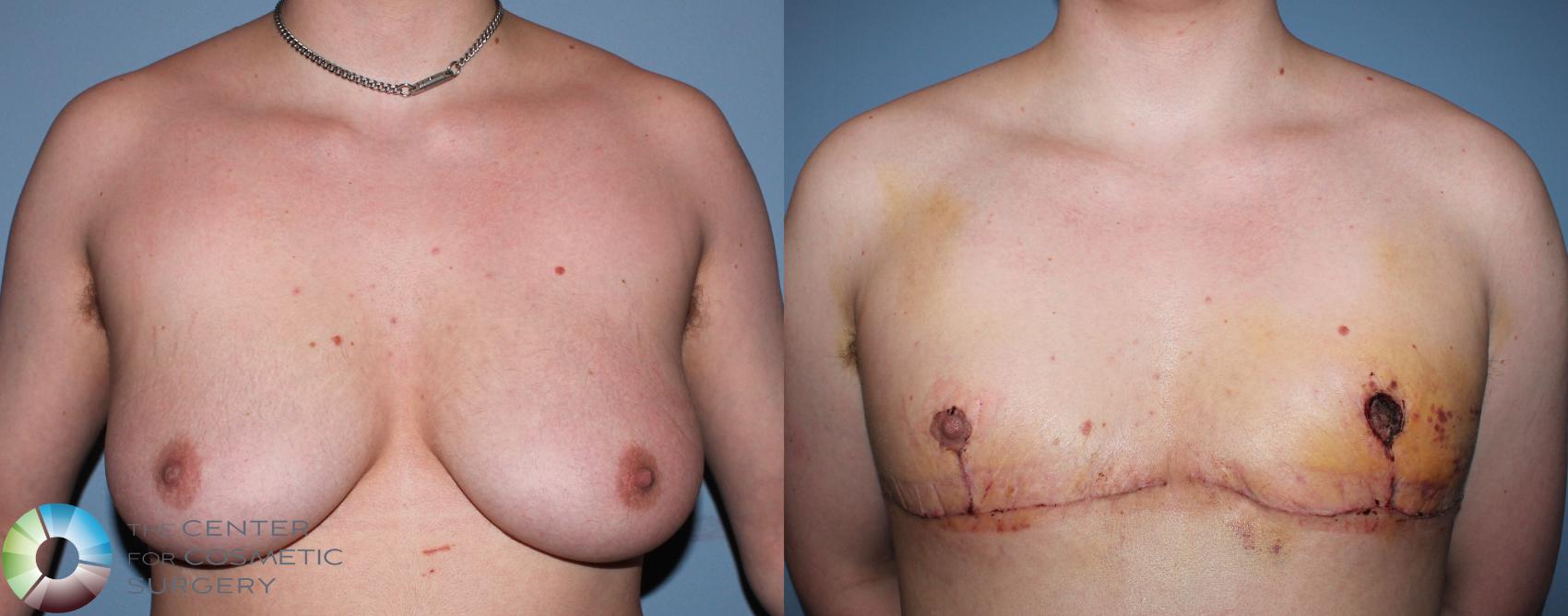 Before & After FTM Top Surgery/Chest Masculinization Case 11203 Front in Denver and Colorado Springs, CO