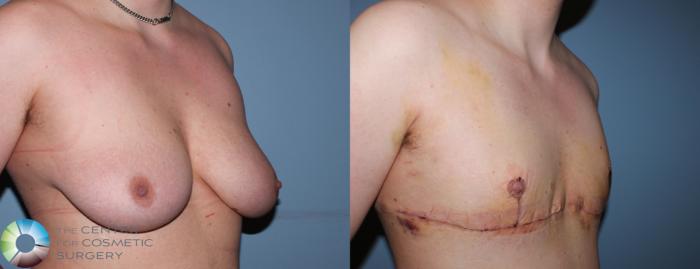 Before & After FTM Top Surgery/Chest Masculinization Case 11203 Right Oblique in Denver and Colorado Springs, CO