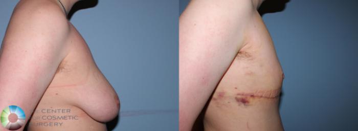 Before & After FTM Top Surgery/Chest Masculinization Case 11203 Right Side in Denver and Colorado Springs, CO