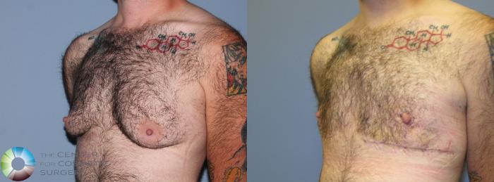 Before & After FTM Top Surgery/Chest Masculinization Case 11204 Left Oblique in Denver and Colorado Springs, CO