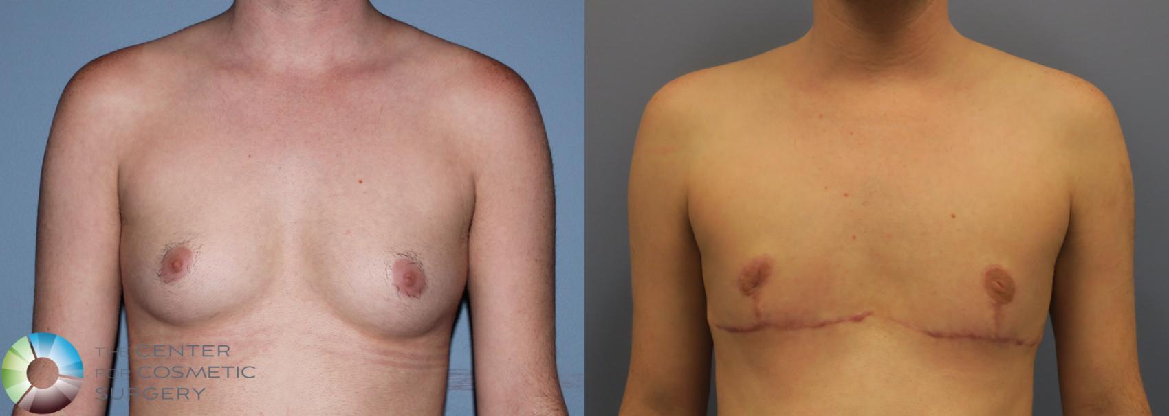 Before & After FTM Top Surgery/Chest Masculinization Case 11205 Front in Denver, CO