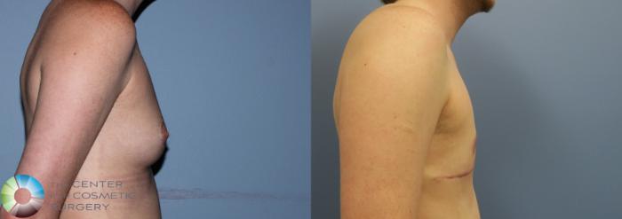 Before & After FTM Top Surgery/Chest Masculinization Case 11205 Right Side in Denver, CO