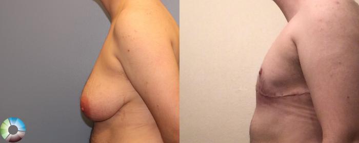 Before & After FTM Top Surgery/Chest Masculinization Case 11209 Left Side in Denver, CO