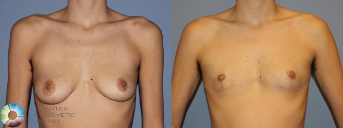 Before & After FTM Top Surgery/Chest Masculinization Case 11211 Front in Denver and Colorado Springs, CO