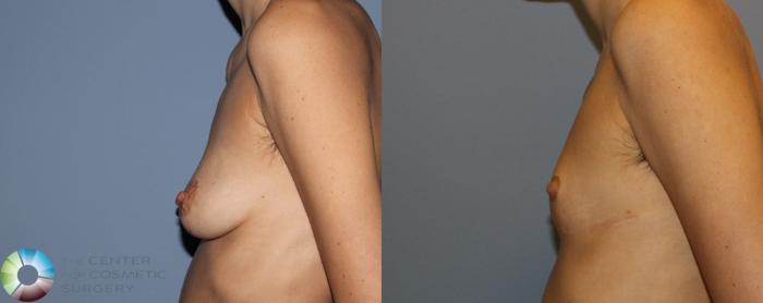 Before & After FTM Top Surgery/Chest Masculinization Case 11211 Left Side in Denver and Colorado Springs, CO