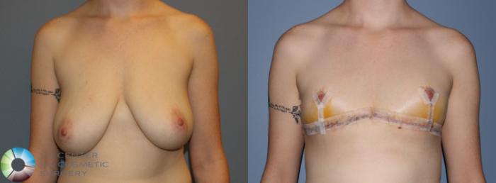 Before & After FTM Top Surgery/Chest Masculinization Case 11212 Front in Denver, CO