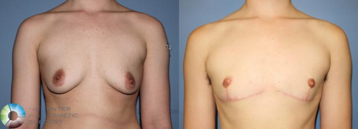 Before & After FTM Top Surgery/Chest Masculinization Case 11213 Front in Denver and Colorado Springs, CO