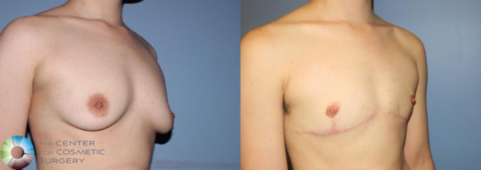 Before & After FTM Top Surgery/Chest Masculinization Case 11213 Right Oblique in Denver and Colorado Springs, CO
