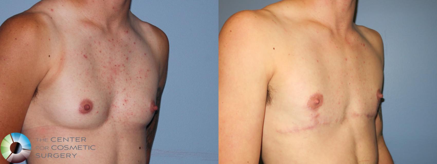 Before & After FTM Top Surgery/Chest Masculinization Case 11274 Right Oblique in Denver and Colorado Springs, CO
