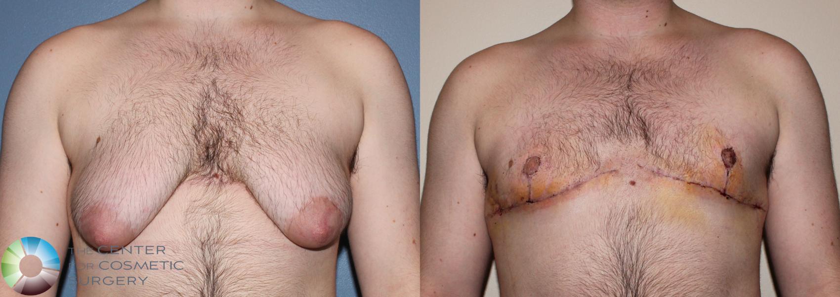 Before & After FTM Top Surgery/Chest Masculinization Case 11275 Front in Denver, CO