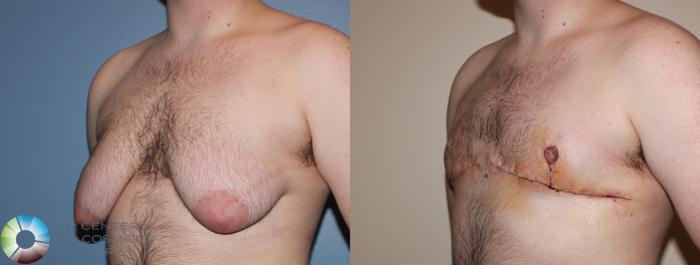 Before & After FTM Top Surgery/Chest Masculinization Case 11275 Left Oblique in Denver, CO