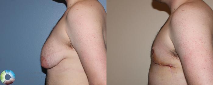 Before & After FTM Top Surgery/Chest Masculinization Case 11275 Left Side in Denver, CO