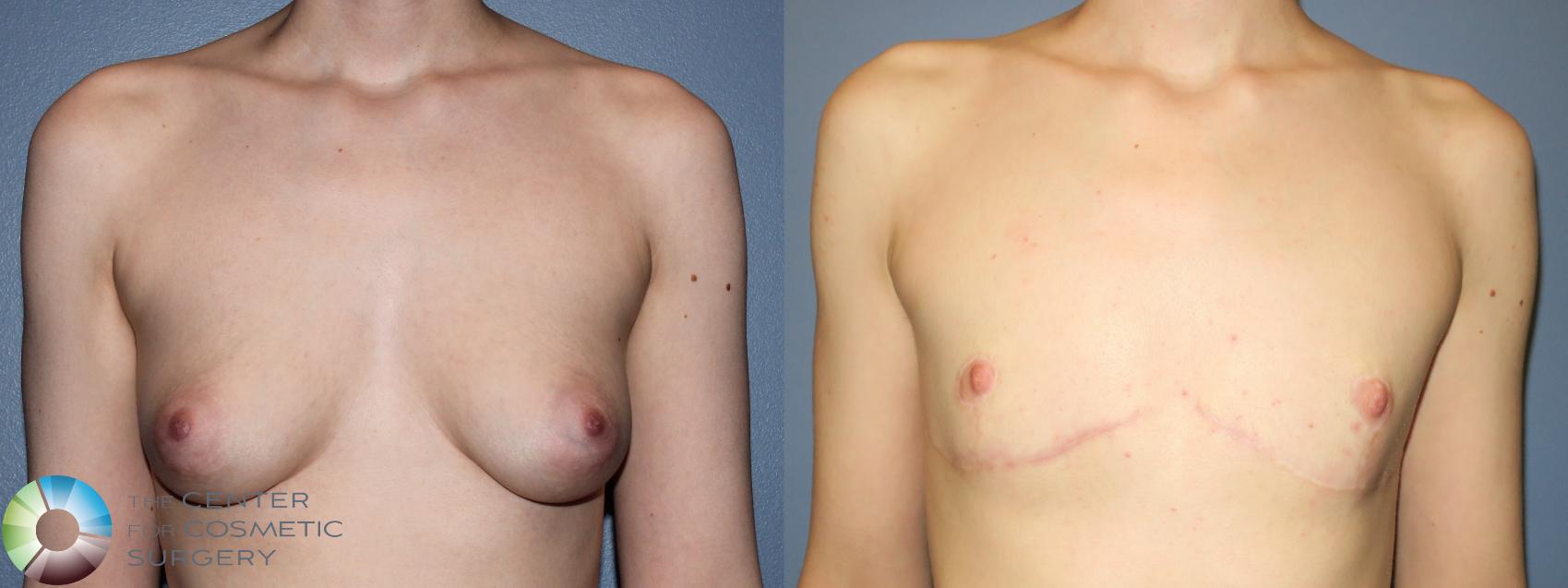 Before & After FTM Top Surgery/Chest Masculinization Case 11276 Front in Denver and Colorado Springs, CO