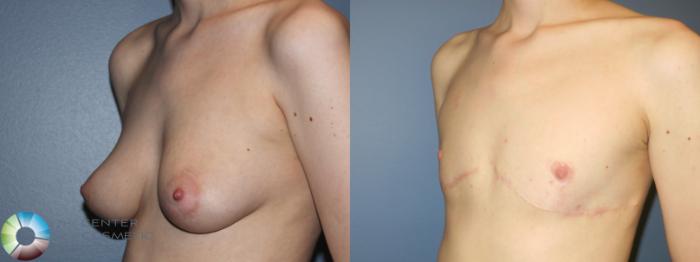 Before & After FTM Top Surgery/Chest Masculinization Case 11276 Left Oblique in Denver and Colorado Springs, CO