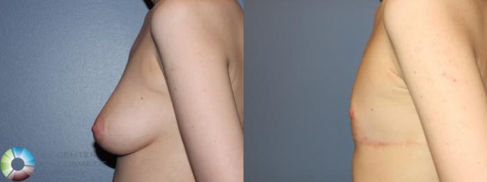 Before & After FTM Top Surgery/Chest Masculinization Case 11276 Left Side in Denver and Colorado Springs, CO