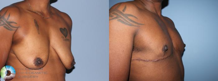 Before & After FTM Top Surgery/Chest Masculinization Case 11277 Right Oblique in Denver, CO