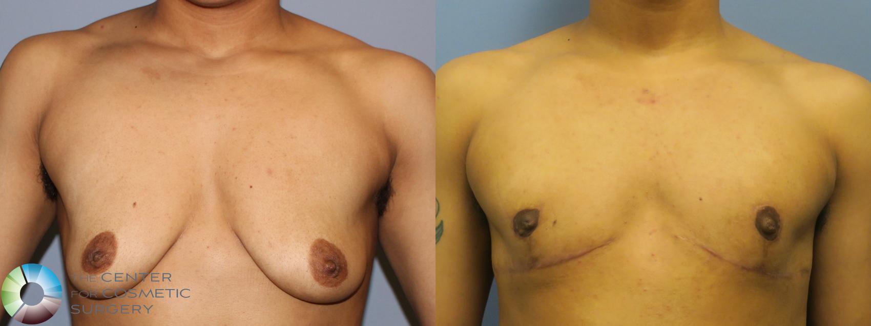Before & After FTM Top Surgery/Chest Masculinization Case 11282 Front in Denver, CO