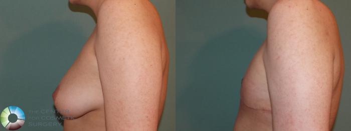 Before & After FTM Top Surgery/Chest Masculinization Case 11417 Left Side in Denver, CO