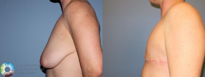 Before & After FTM Top Surgery/Chest Masculinization Case 11418 Left Side in Denver and Colorado Springs, CO