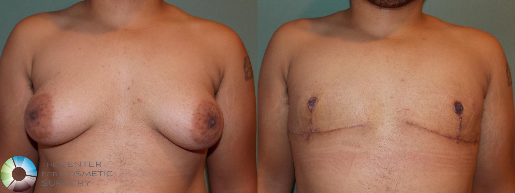 Before & After FTM Top Surgery/Chest Masculinization Case 11424 Front in Denver and Colorado Springs, CO