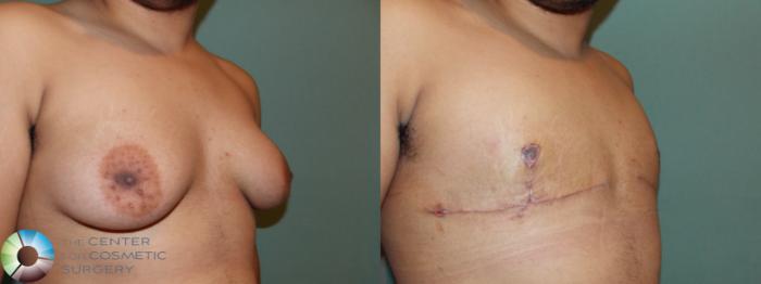 Before & After FTM Top Surgery/Chest Masculinization Case 11424 Right Oblique in Denver and Colorado Springs, CO