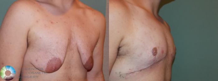 Before & After FTM Top Surgery/Chest Masculinization Case 11425 Right Oblique in Denver and Colorado Springs, CO