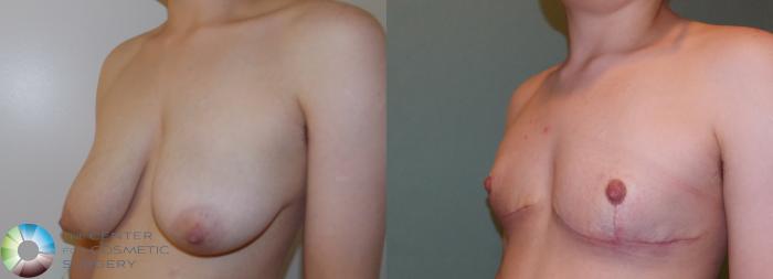 Before & After FTM Top Surgery/Chest Masculinization Case 11426 Left Oblique in Denver and Colorado Springs, CO