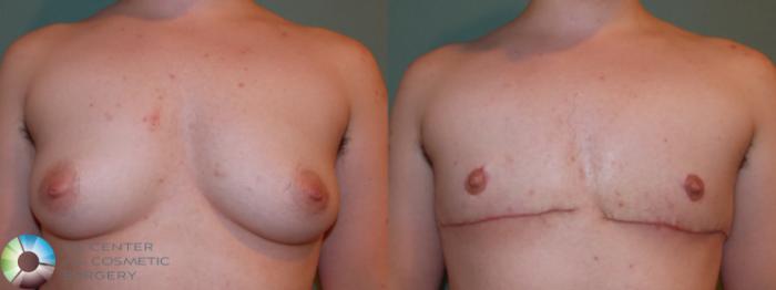 Before & After FTM Top Surgery/Chest Masculinization Case 11427 Front in Denver and Colorado Springs, CO