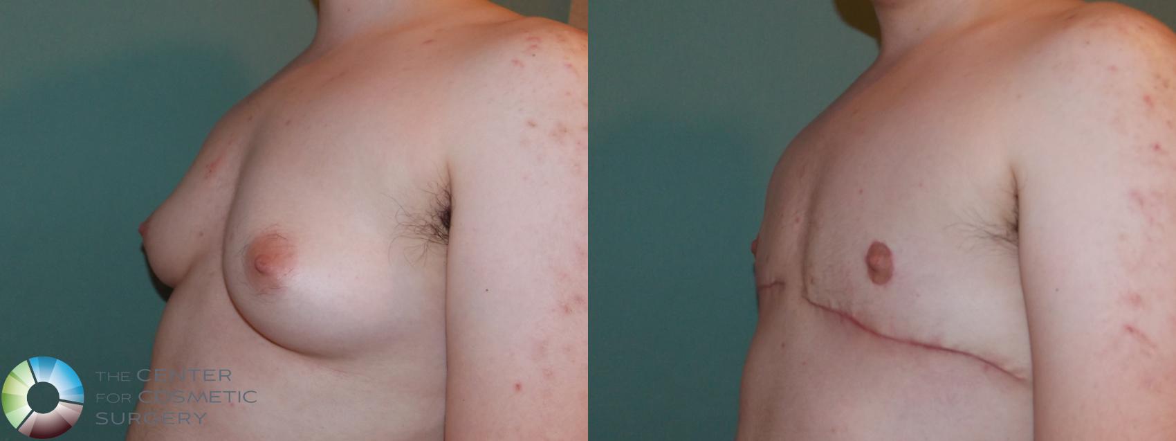 Before & After FTM Top Surgery/Chest Masculinization Case 11427 Right Oblique in Denver and Colorado Springs, CO