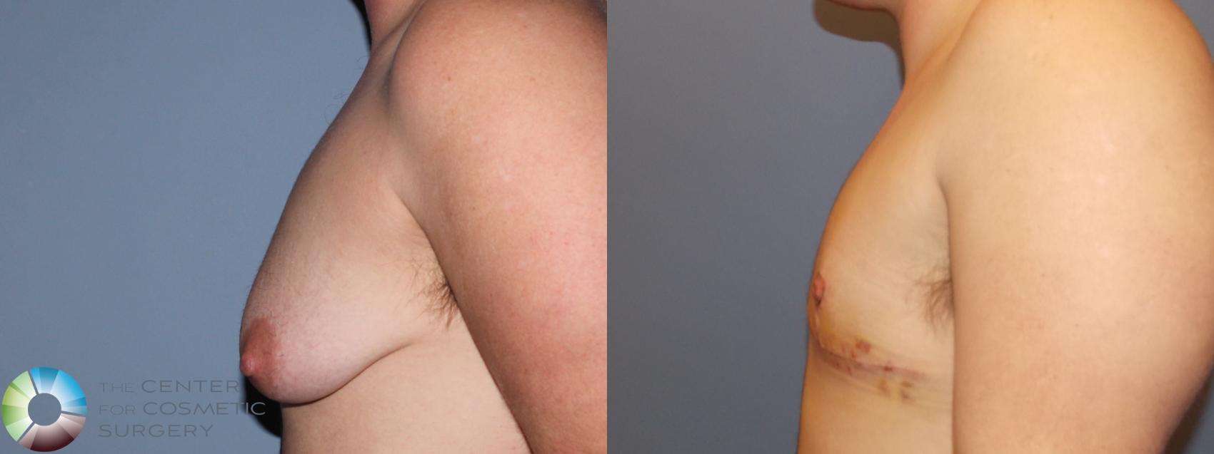 Before & After FTM Top Surgery/Chest Masculinization Case 11428 Left Side in Denver and Colorado Springs, CO