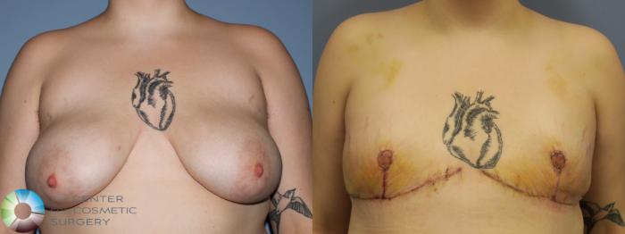 Before & After FTM Top Surgery/Chest Masculinization Case 11429 Front in Denver and Colorado Springs, CO