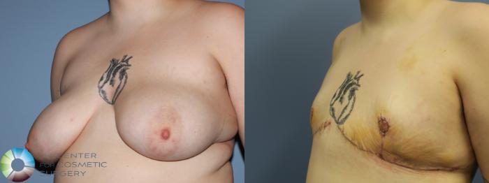 Before & After FTM Top Surgery/Chest Masculinization Case 11429 Left Oblique in Denver and Colorado Springs, CO