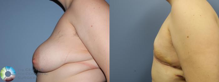 Before & After FTM Top Surgery/Chest Masculinization Case 11429 Left Side in Denver and Colorado Springs, CO