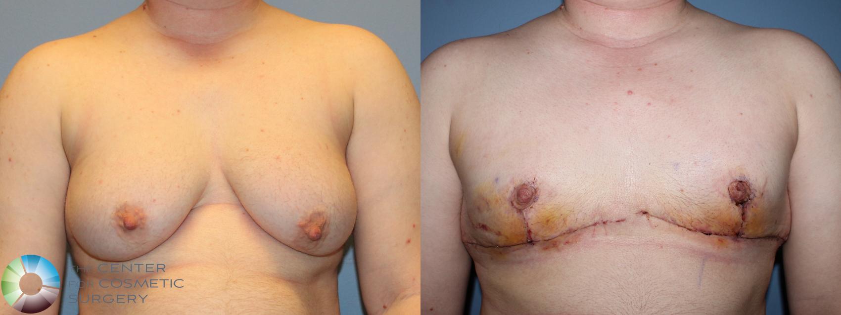 Before & After FTM Top Surgery/Chest Masculinization Case 11430 Front in Denver and Colorado Springs, CO