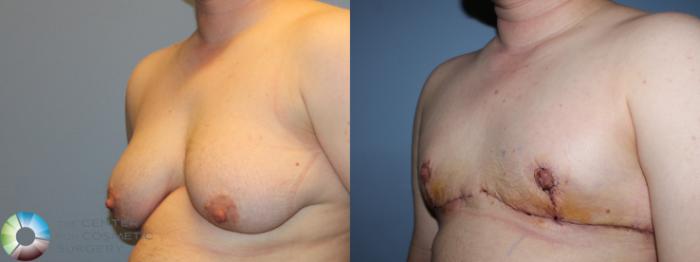 Before & After FTM Top Surgery/Chest Masculinization Case 11430 Left Oblique in Denver and Colorado Springs, CO