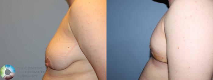 Before & After FTM Top Surgery/Chest Masculinization Case 11430 Left Side in Denver and Colorado Springs, CO