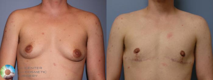 Before & After FTM Top Surgery/Chest Masculinization Case 11431 Front in Denver, CO