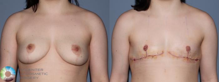 Before & After FTM Top Surgery/Chest Masculinization Case 11433 Front in Denver and Colorado Springs, CO