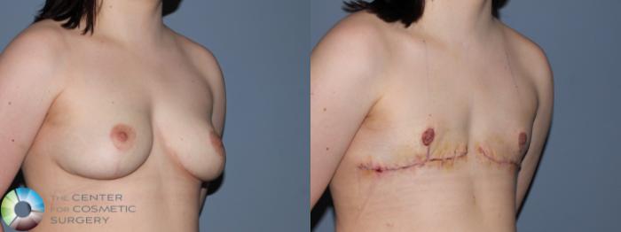 Before & After FTM Top Surgery/Chest Masculinization Case 11433 Left Oblique in Denver and Colorado Springs, CO
